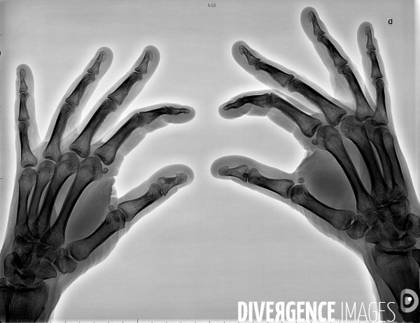 Radiographie de 2 mains de femme
