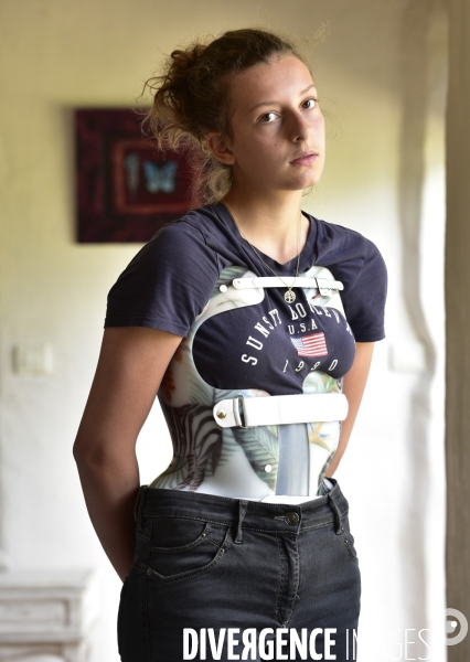 Scoliose : Une jeune adolescente et son corset