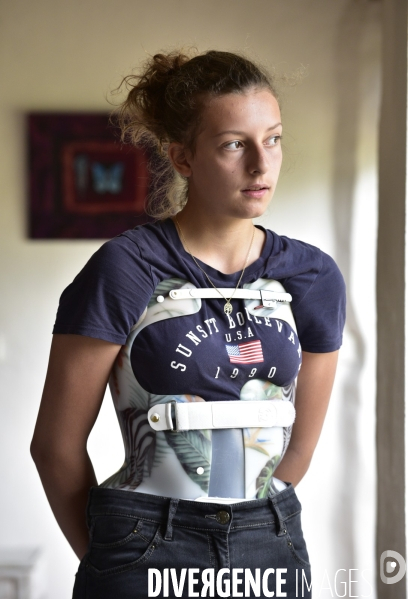 Scoliose : Une jeune adolescente et son corset