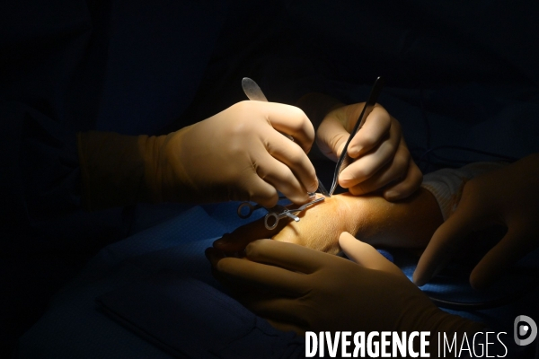 Chirurgie de la main -Implantation d une prothèse miniature pour le traitement de l arthrose de la main ou du poignet, par le Docteur Cristian COUTURIER à la clinique Arago à Paris