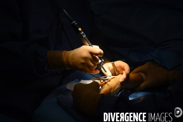 Chirurgie de la main -Implantation d une prothèse miniature pour le traitement de l arthrose de la main ou du poignet, par le Docteur Cristian COUTURIER à la clinique Arago à Paris