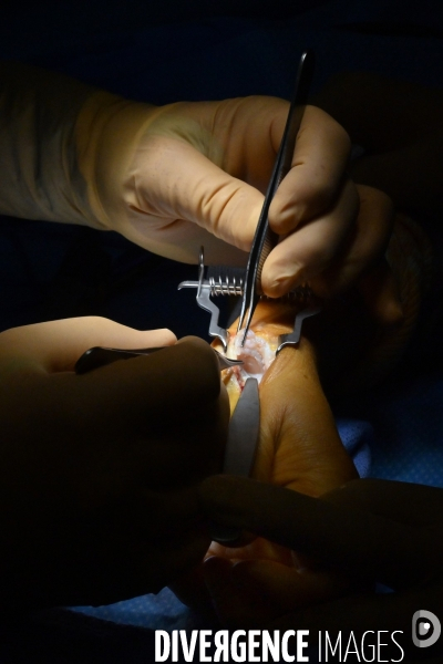 Chirurgie de la main -Implantation d une prothèse miniature pour le traitement de l arthrose de la main ou du poignet, par le Docteur Cristian COUTURIER à la clinique Arago à Paris