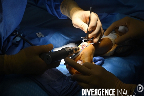 Chirurgie de la main -Implantation d une prothèse miniature pour le traitement de l arthrose de la main ou du poignet, par le Docteur Cristian COUTURIER à la clinique Arago à Paris