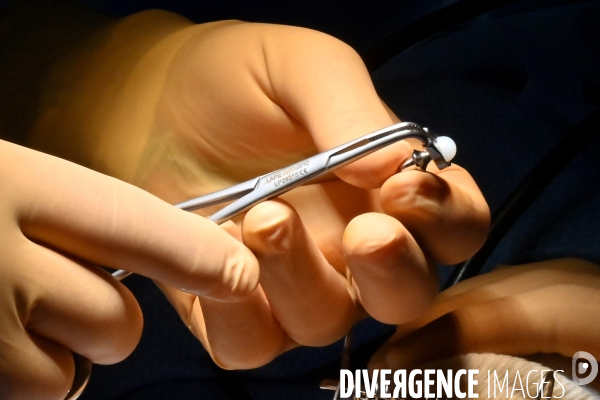 Chirurgie de la main -Implantation d une prothèse miniature pour le traitement de l arthrose de la main ou du poignet, par le Docteur Cristian COUTURIER à la clinique Arago à Paris