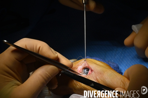 Chirurgie de la main -Implantation d une prothèse miniature pour le traitement de l arthrose de la main ou du poignet, par le Docteur Cristian COUTURIER à la clinique Arago à Paris