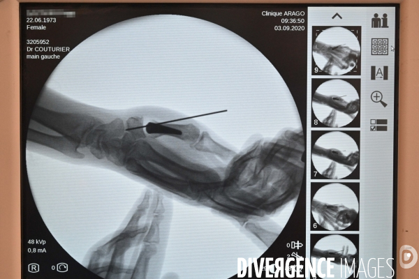 Chirurgie de la main -Implantation d une prothèse miniature pour le traitement de l arthrose de la main ou du poignet, par le Docteur Cristian COUTURIER à la clinique Arago à Paris