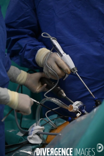 Chirurgie de l endométriose -  Au centre d Endométriose de la clinique TIVOLI DUCOS  de Bordeaux , dirigé par le professeur Horace ROMAN