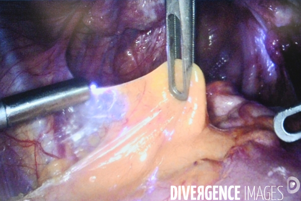 Chirurgie de l endométriose -  Au centre d Endométriose de la clinique TIVOLI DUCOS  de Bordeaux , dirigé par le professeur Horace ROMAN